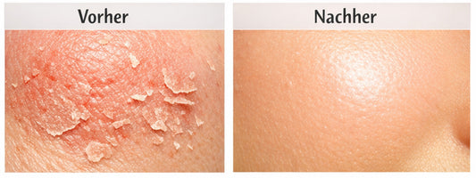 Hautbarriere stärken: Was sie ist & warum deine Pflege ohne sie scheitert